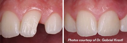 Filtek™ Supreme Ultra Universal Restorative anterior three shade technique
