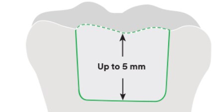 illustration of tooth showing 5mm depth
