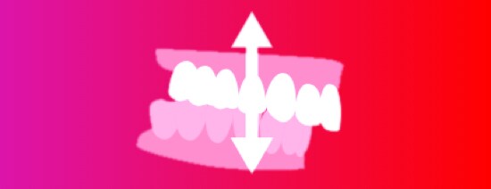An illustration of an overbite with arrows pointing up and down.
