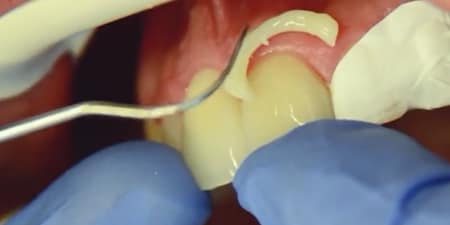 Easy excess clean-up
