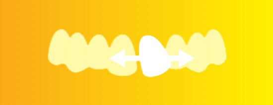 An illustration of a row of teeth with one tooth misaligned and arrows pointing out from either side of the misaligned tooth.
