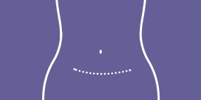 PREVENA RESTOR BELLA•FORM™ Incision Management System

