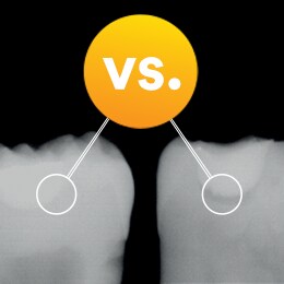 radiopaque (left) vs. radiolucent (right) dental adhesive comparison