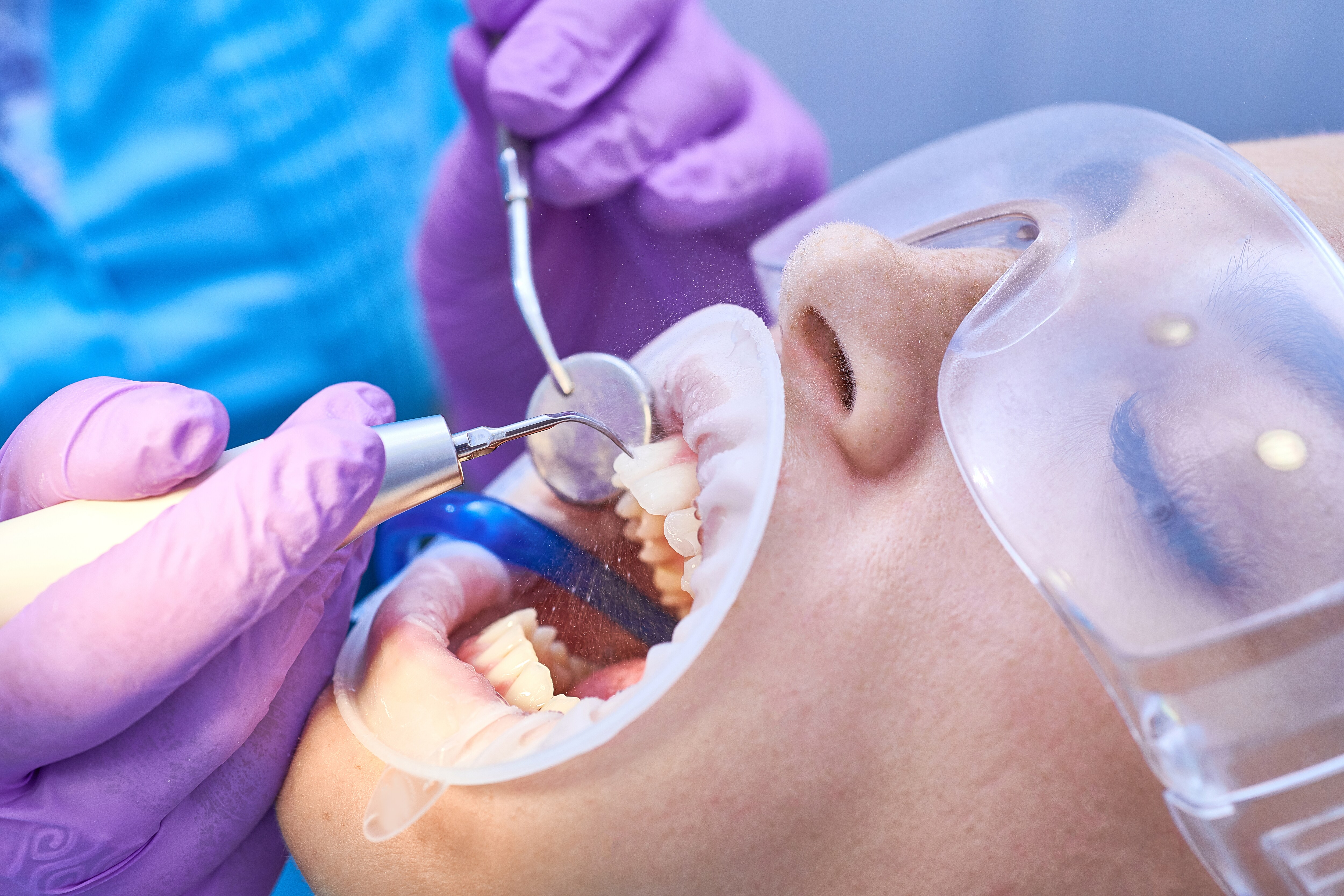 Paciente acostado en la silla del odontólogo pasando por la limpieza de los dientes
