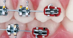 Braces with red bands on teeth.