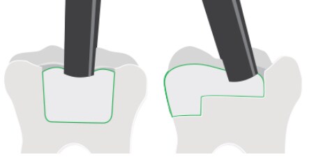 illustration of teeth showing placement
